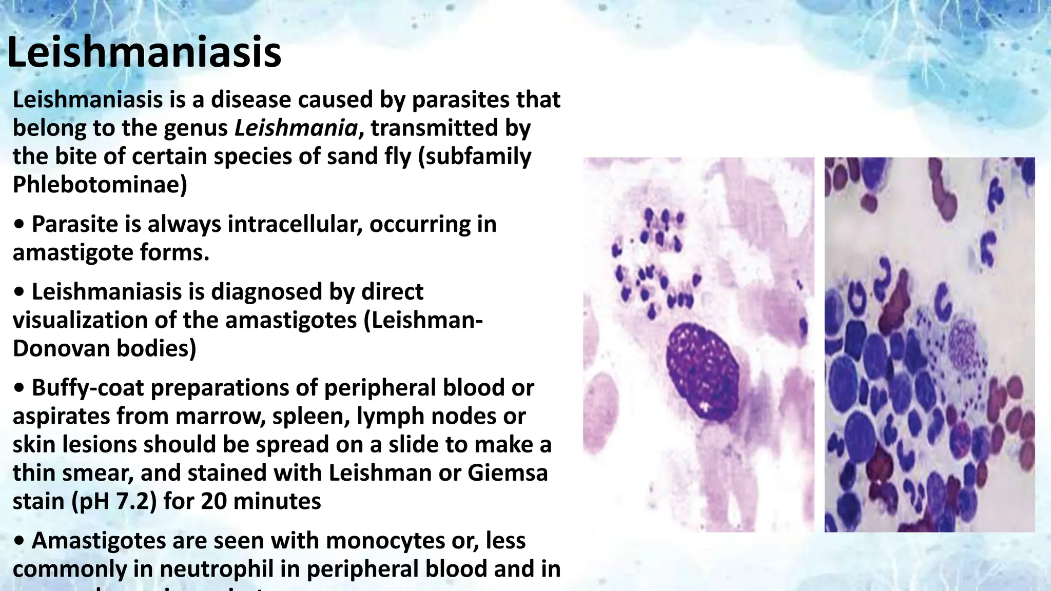 Leishmaniasis
Leishmaniasis is a disease caused by parasites that
belong to the genus Leishmania, transmitted by
the bite of certain species of sand fly (subfamily
Phlebotominae)
• Parasite is always intracellular, occurring in
amastigote forms.
• Leishmaniasis is diagnosed by direct
visualization of the amastigotes (Leishman-
Donovan bodies)
• Buffy-coat preparations of peripheral blood or
aspirates from marrow, spleen, lymph nodes or
skin lesions should be spread on a slide to make a
thin smear, and stained with Leishman or Giemsa
stain (pH 7.2) for 20 minutes
• Amastigotes are seen with monocytes or, less
commonly in neutrophil in peripheral blood and in
 