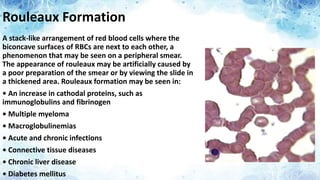 True Rouleaux Rbc PERIPHERAL BLOOD SMEAR (STAINING, CELLS AND CONDITIONS) | PPTX