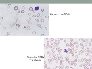 Peripheral Blood SMear-piyabi pathology .pptx
