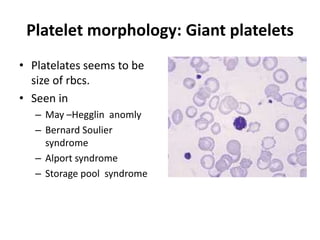 Platelet morphology: Giant platelets
• Platelates seems to be
size of rbcs.
• Seen in
– May –Hegglin anomly
– Bernard Soulier
syndrome
– Alport syndrome
– Storage pool syndrome
 