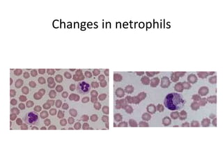 Changes in netrophils
 