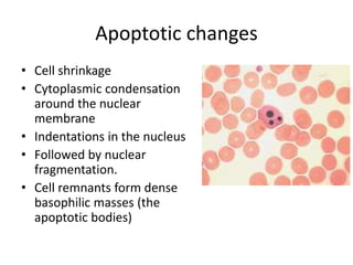 Apoptotic changes
• Cell shrinkage
• Cytoplasmic condensation
around the nuclear
membrane
• Indentations in the nucleus
• Followed by nuclear
fragmentation.
• Cell remnants form dense
basophilic masses (the
apoptotic bodies)
 