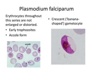 Plasmodium falciparum
Erythrocytes throughout
this series are not
enlarged or distorted.
• Early trophozoites
• Accole form
• Crescent (‘banana-
shaped’) gametocyte
 