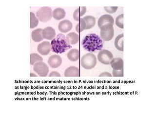 Schizonts are commonly seen in P. vivax infection and appear
as large bodies containing 12 to 24 nuclei and a loose
pigmented body. This photograph shows an early schizont of P.
vivax on the left and mature schizonts
 