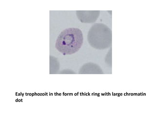 Ealy trophozoit in the form of thick ring with large chromatin
dot
 