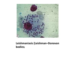 Leishmaniasis (Leishman–Donovan
bodies)
 