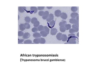African trypanosomiasis
(Trypanosoma brucei gambiense)
 