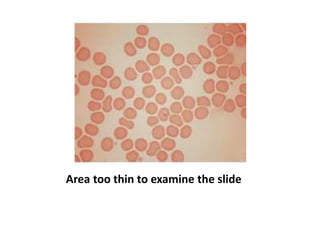 Area too thin to examine the slide
 