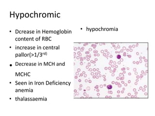 Hypochromic
• Dcrease in Hemoglobin
content of RBC
• increase in central
pallor(>1/3rd)
• Decrease in MCH and
MCHC
• Seen in Iron Deficiency
anemia
• thalassaemia
• hypochromia
 