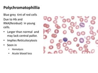 Polychromatophillia
Blue grey tint of red cells
Due to Hb and
RNA(Residual) in young
cells.
• Larger than normal and
may lack central pallor.
• Implies Reticulocytosis
• Seen in
• Hemolysis
• Acute blood loss
 
