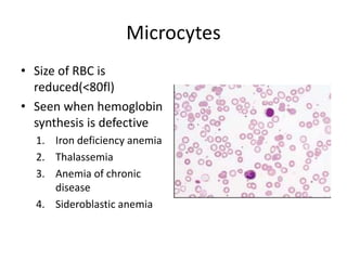 Microcytes
• Size of RBC is
reduced(<80fl)
• Seen when hemoglobin
synthesis is defective
1. Iron deficiency anemia
2. Thalassemia
3. Anemia of chronic
disease
4. Sideroblastic anemia
 