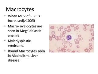 Macrocytes
• When MCV of RBC is
Increased(>100fl)
• Macro- ovalocytes are
seen in Megaloblastic
anemia
• Myledysplastic
syndrome.
• Round Macrocytes seen
in Alcoholism, Liver
disease.
 