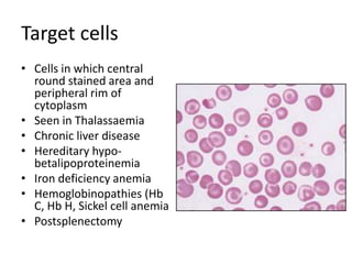 Target cells
• Cells in which central
round stained area and
peripheral rim of
cytoplasm
• Seen in Thalassaemia
• Chronic liver disease
• Hereditary hypo-
betalipoproteinemia
• Iron deficiency anemia
• Hemoglobinopathies (Hb
C, Hb H, Sickel cell anemia
• Postsplenectomy
 
