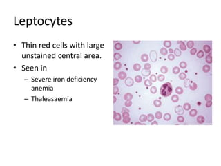 Leptocytes
• Thin red cells with large
unstained central area.
• Seen in
– Severe iron deficiency
anemia
– Thaleasaemia
 