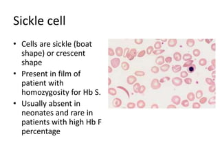 Sickle cell
• Cells are sickle (boat
shape) or crescent
shape
• Present in film of
patient with
homozygosity for Hb S.
• Usually absent in
neonates and rare in
patients with high Hb F
percentage
 
