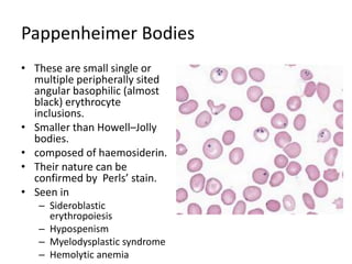Pappenheimer Bodies
• These are small single or
multiple peripherally sited
angular basophilic (almost
black) erythrocyte
inclusions.
• Smaller than Howell–Jolly
bodies.
• composed of haemosiderin.
• Their nature can be
confirmed by Perls’ stain.
• Seen in
– Sideroblastic
erythropoiesis
– Hypospenism
– Myelodysplastic syndrome
– Hemolytic anemia
 
