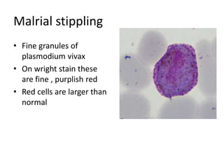 Malrial stippling
• Fine granules of
plasmodium vivax
• On wright stain these
are fine , purplish red
• Red cells are larger than
normal
 