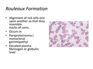 Rouleaux Formation
• Alignment of red cells one
upon another so that they
resemble
stacks of coins.
• Occurs in
• Paraproteinemia (
monoclonal
gammopathy)
• Elevated plasma
fibrinogen or globulin
level
 