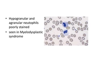 • Hypogranular and
agranular neutophils
poorly stained
• seen in Myelodysplastic
syndrome
 