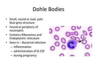 Dohle Bodies
• Small, round or oval, pale
blue-grey structure
• Found at periphery of
neutrophil.
• Contains Ribosomes and
Endoplasmic reticulum
• Seen in – Bacterial infection
– inflammation
– administration of G-CSF
– during pregnancy
 