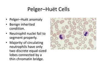 Pelger–Huët Cells
• Pelger–Huët anomaly
• Benign inherited
condition.
• Neutrophil nuclei fail to
segment properly.
• Majority of circulating
neutrophils have only
two discrete equal-sized
lobes connected by a
thin chromatin bridge.
 
