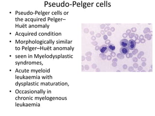 Pseudo-Pelger cells
• Pseudo-Pelger cells or
the acquired Pelger–
Huët anomaly
• Acquired condition
• Morphologically similar
to Pelger–Huët anomaly
• seen in Myelodysplastic
syndromes,
• Acute myeloid
leukaemia with
dysplastic maturation,
• Occasionally in
chronic myelogenous
leukaemia
 