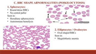 Oval Rbc PERIPHERAL BLOOD SMEAR OBSERVATIONS.pptx