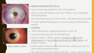 • KERATOCONJUNCTIVITIS SICCA
• most common associated (15–25% of RA patients)
• gritty or sandy FB sensation, burning, irritation, mucus discharge,
and photophobia
• diminished tear meniscus, Schirmer test - decreased tear production
• Punctate epithelial keratopathy, mucus stranding, and filamentary
keratitis
• SCLERITIS
• 20% of RA patients, isolated episcleritis in up to 11%
• severe boring ocular pain and photophobia
• Anterior scleritis - diffuse, nodular, necrotizing scleritis with
inflammation and necrotizing scleritis without inflammation, and
posterior scleritis.
• exhibit zones of intense scleral inflammation, edema, and necrosis
with overlying epithelial defects
• Also referred to as scleromalacia perforans - Severe scleral thinning
diffuse anterior scleritis
 