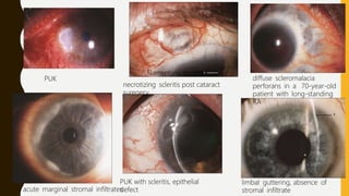 necrotizing scleritis post cataract
suregery
filamentary keratitis
diffuse scleromalacia
perforans in a 70-year-old
patient with long-standing
RA
acute marginal stromal infiltrates
PUK with scleritis, epithelial
defect
limbal guttering, absence of
stromal infiltrate
PUK
 