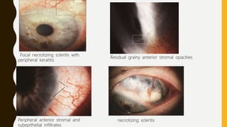 Focal necrotizing scleritis with
peripheral keratitis
Residual grainy anterior stromal opacities
Peripheral anterior stromal and
subepithelial infiltrates
necrotizing scleritis
 