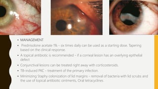• MANAGEMENT
• Prednisolone acetate 1% - six times daily can be used as a starting dose. Tapering
based on the clinical response.
• A topical antibiotic is recommended - if a corneal lesion has an overlying epithelial
defect
• Conjunctival lesions can be treated right away with corticosteroids.
• TB-induced PKC - treatment of the primary infection.
• Minimizing Staphy colonization of lid margins - removal of bacteria with lid scrubs and
the use of topical antibiotic ointments, Oral tetracyclines
 