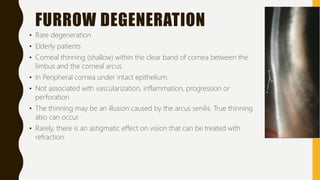 FURROW DEGENERATION
• Rare degeneration
• Elderly patients
• Corneal thinning (shallow) within the clear band of cornea between the
limbus and the corneal arcus
• In Peripheral cornea under intact epithelium.
• Not associated with vascularization, inflammation, progression or
perforation
• The thinning may be an illusion caused by the arcus senilis. True thinning
also can occur.
• Rarely, there is an astigmatic effect on vision that can be treated with
refraction.
 