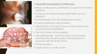 • PSEUDOEPITHELIOMATOUS HYPERPLASIA
• Benign, rapidly growing proliferation of conjunctival or corneal
epithelium
• In response to some preexisting inflammation such as a
pterygium
• A white elevated mass with hyperkeratotic surface.
• A central umbilication may be present
• Lateral margins of the lesion show a smooth transition into
surrounding normal epithelium
• Can mimic ocular surface neoplasia
• Histopathologically – acanthosis which may be pushed
downward into substantia propria, forming lobules of
squamous cells with keratin whorls.
• Precarcinomatous
• Simple excision is usually curative
 