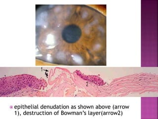  epithelial denudation as shown above (arrow
1), destruction of Bowman’s layer(arrow2)
 