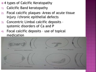  4 types of Calcific Keratopathy
1) Calicific Band keratopathy
2) Focal calcific plaques- Areas of acute tissue
injury /chronic epithelial defects
3) Concentric Limbal calcific deposits –
systemic disorders of Ca and P
4) Focal calcific deposits – use of topical
medication
5) PICTURE FROM LEIBOWITZ
 
