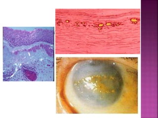  Picture of climatic droplet keratopathy
 