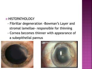 HISTOPATHOLOGY
- Fibrillar degeneration -Bowman’s Layer and
stromal lamellae- responsible for thinning
- Cornea becomes thinner with appearance of
a subepithelial pannus
 