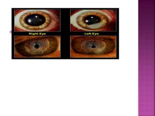  MANAGEMENT
- Large amount of irregular astigmatism –
precludes treatment with spectacles and
contact lenses
 