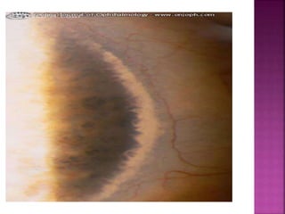  Picture of vogt’s limbal girdle
 