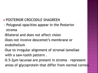  POSTERIOR CROCODILE SHAGREEN
- Polygonal opacities appear in the Posterior
stroma
-Bilateral and does not affect vision
-Does not involve descemet’s membrane or
endothelium
-Due to irregular alignment of stromal lamellae
with a saw-tooth pattern .
-0.5-2µm lacunae are present in stroma – represent
areas of glycoprotein that differ from normal cornea
 