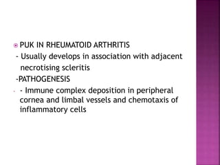  PUK IN RHEUMATOID ARTHRITIS
- Usually develops in association with adjacent
necrotising scleritis
-PATHOGENESIS
- - Immune complex deposition in peripheral
cornea and limbal vessels and chemotaxis of
inflammatory cells
 