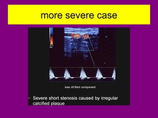 more severe case
 