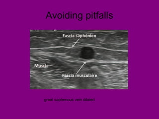 Avoiding pitfalls
great saphenous vein dilated
 