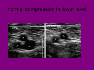 normal compression in lower level
 