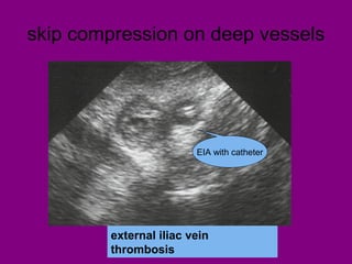 skip compression on deep vessels
external iliac vein
thrombosis
EIA with catheter
 