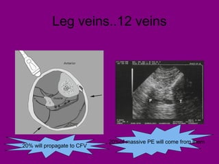 Leg veins..12 veins
20%of massive PE will come from them
20% will propagate to CFV
 