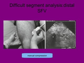 Difficult segment analysis:distal
SFV
manual compression
 