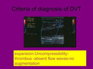 Criteria of diagnosis of DVT
expansion-Uncompressibility-
thrombus -absent flow waves-no
augmentation
 