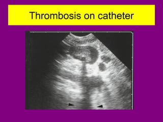 Thrombosis on catheter
 