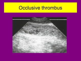Occlusive thrombus
 